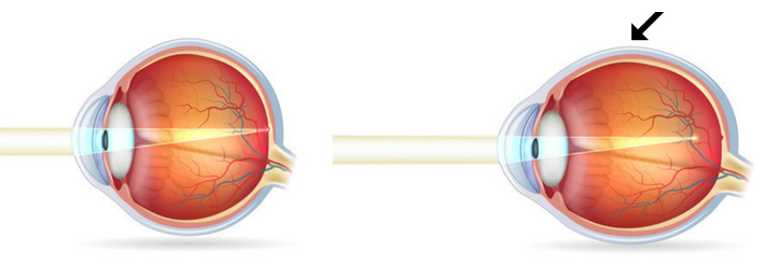 Understanding Myopia