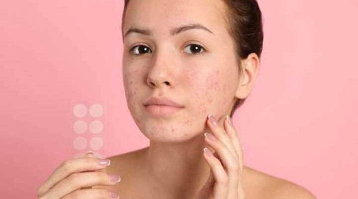 What Are the Benefits of Using Pimple Patches