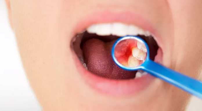 Can Dental Implants Cause Gum Disease