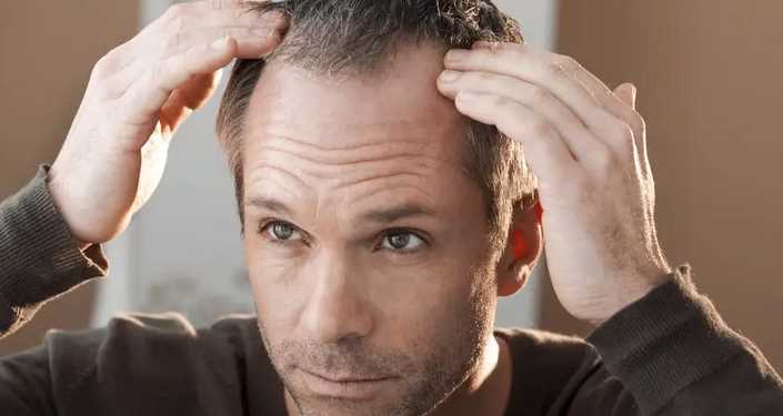 How to prevent and reduce balding before it gets worse