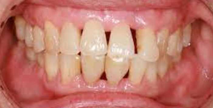 Is It Possible To Cure Periodontal Disease