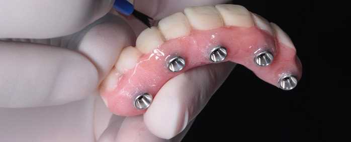 What Are All on 4 Dental Implant Procedures