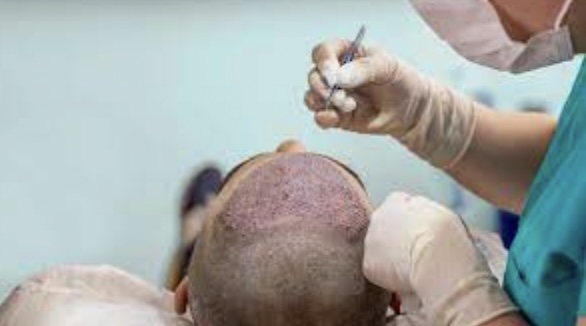 Things to Consider During FUE Hair Transplant