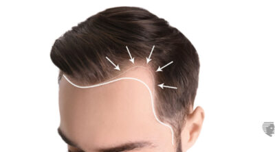 How A Traction Alopecia Treatment Can Help Regain Hair