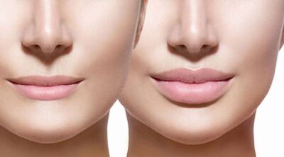 Why Lips Are the Highest Risk Area for Filler