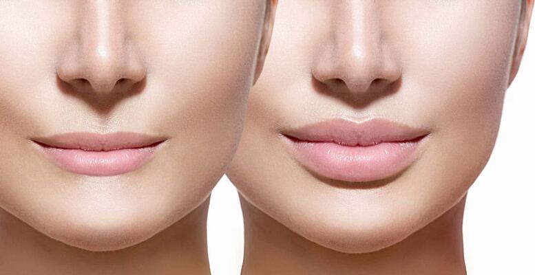 Why Lips Are the Highest Risk Area for Filler